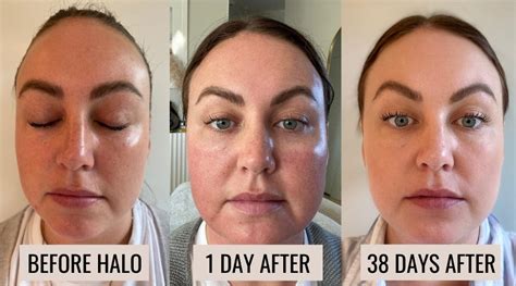 We Tried Halo Fractional Laser And Heres What We Really Thought With