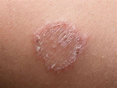 What Is Ringworm Symptoms