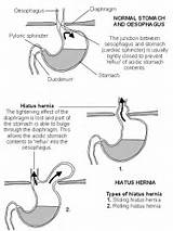 Hiatal Hernia Breathing Exercises