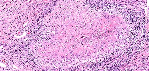 Pathology Outlines Granulomatosis With Polyangiitis Gpa