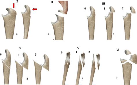 Characterization Of Olecranon Fracture Types A Type I Longitudinal Or