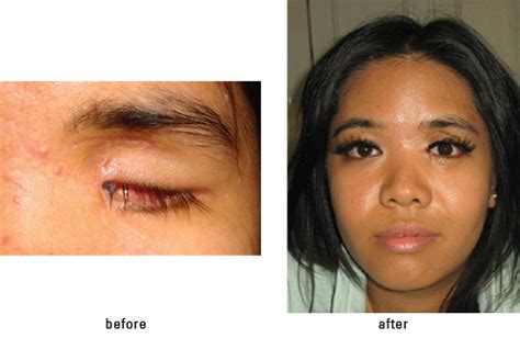 Anophthalmia Eyelid And Socket Surgery With A Prosthetic Eye Fitting