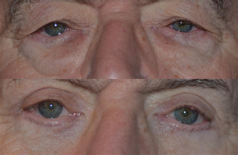 The Best Eyelid Procedure In Denver What The Experts Know
