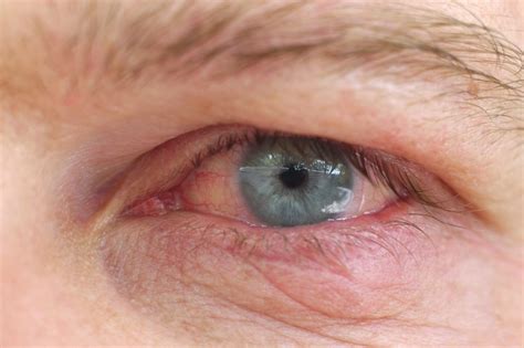 Eye Infection Infection Of An Eyelid On An Eye With Contact Lens Daily Health Alerts