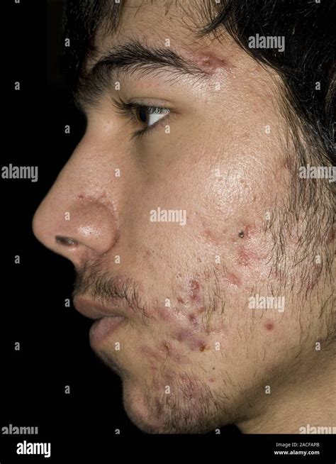 Acne Cheeks Of A Man With Acne And Severe Scarring From Cystic Pimples