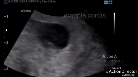 Ectopia Cordis Ultrasound Video 8 Weeks Fetus Youtube