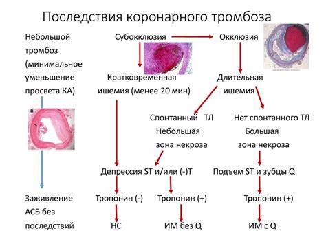 Нестабильная стенокардия диета Острые коронарные синдромы. Инфаркт миокарда и нестабильная стенокардия Острые коронарные синдромы. Инфаркт миокарда и нестабильная стенокардия Нестабильная стенокардия диета