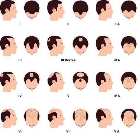 Male Pattern Baldness International Hair Studio