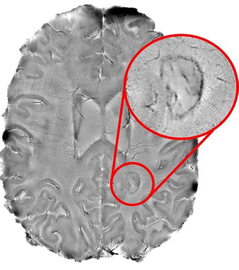 Smoldering Spots In The Brain May Signal Severe Ms