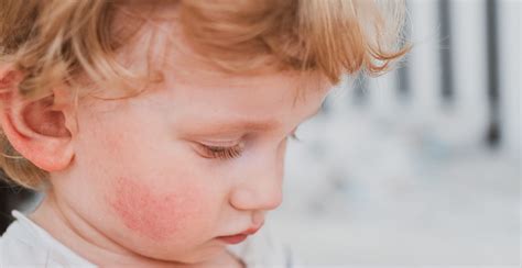 Understanding Fifth Disease Symptoms And Treatment For Children