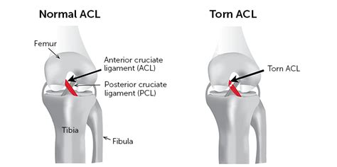 Injuries to the acl may occur next sudden acute, twisting episodes. Knee Ligament Injury - ACL Rehabilitation | Body Works ...