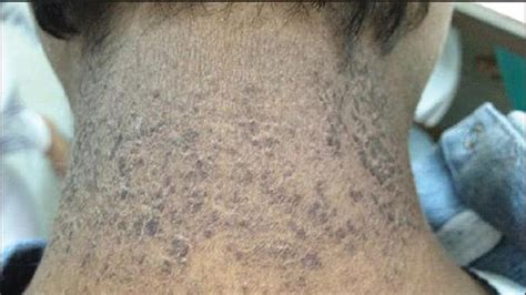 Dermatitis Neglecta Causes Pictures And Treatment