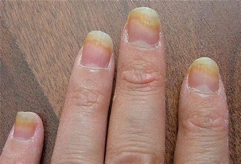 Fingernail Infection Causes Symptoms Pictures Treatment Healthmd