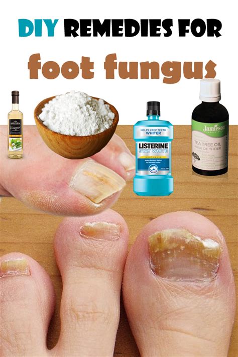 Diy Remedies For Foot Fungus Healthylife