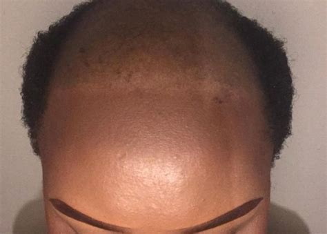 Balayagedarkhair B12 Hair Growth Before And After