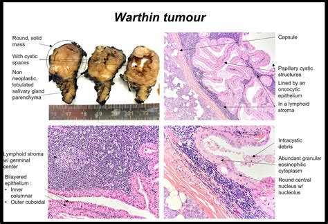 Pathology Outlines Warthin Tumor