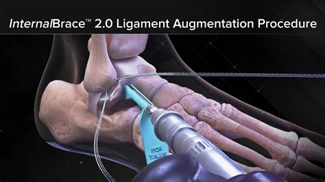 Arthrex Internalbrace Ligament Augmentation Repair For Lateral Ankle