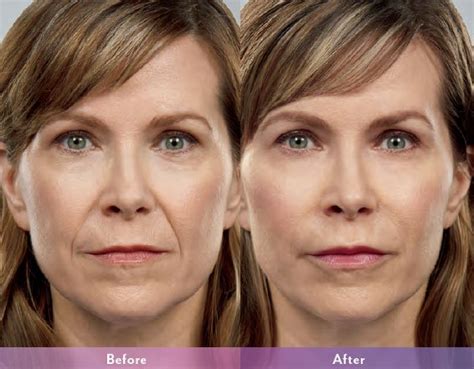 Dermal Filler Scottsdale Smooth And Beautiful Results
