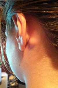 Lump behind ear lobe symptoms. Lump Behind Ear: Pictures, Cyst Behind Ear Causes & Treatment