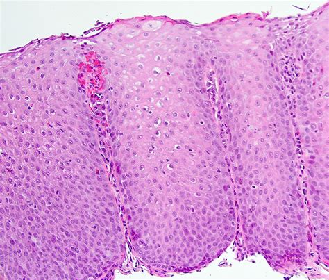Pathology Outlines Reflux Esophagitis Gastroesophageal Reflux Disease