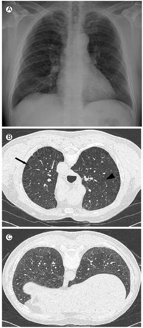 A Pa Chest X Ray Showed Mild Reticular Opacities In Both Lower Lungs