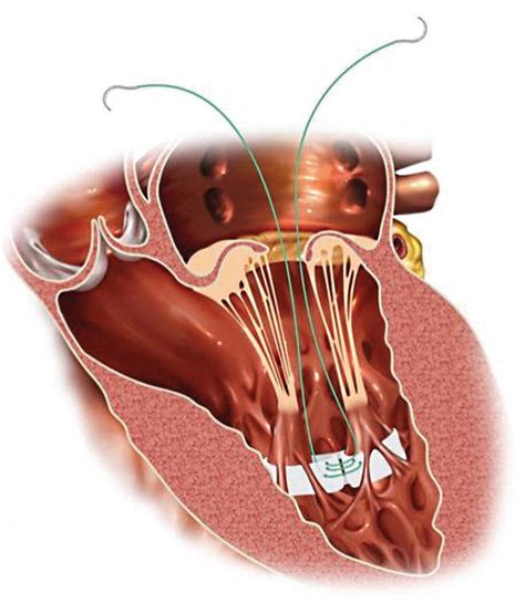 Approaches To Mitral Valve Repair And Replacement Thoracic Key