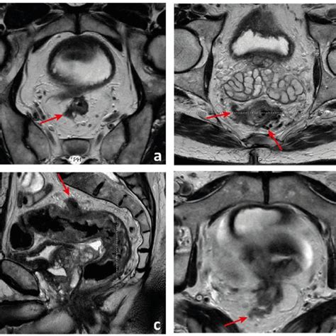 Circumferential Margin Of Resection Involvement A A T3d Tumour Invades Download Scientific