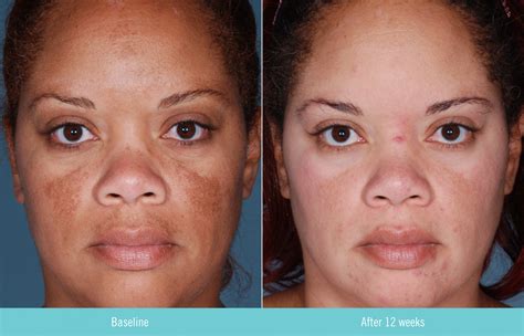 Hydroquinone Before And After