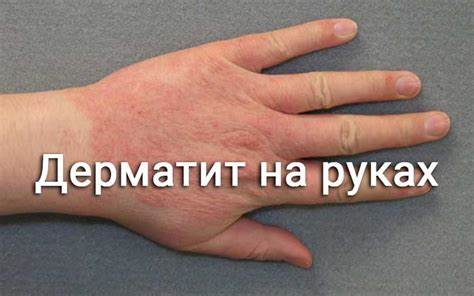 Диета для атопический дерматит