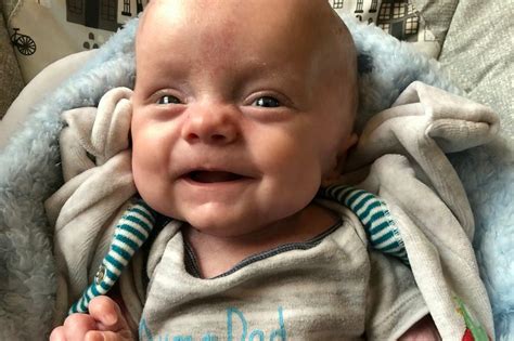 Miracle Baby Born With No Skin And 30 Weeks Premature Defies All Odds
