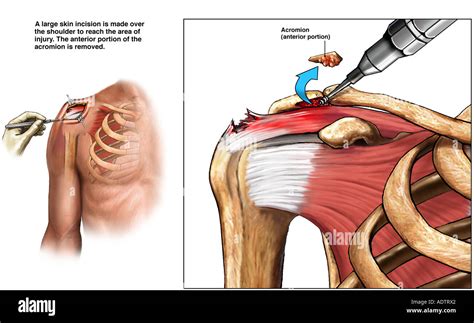 Acromioplasty Shoulder Impingement Syndrome Surgery Stock Photo
