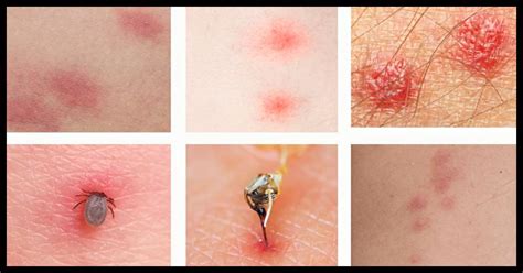10 Bug Bites Everyone Should Be Able To Identify