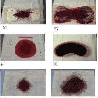 PDF Use Of A Visual Aid In Addition To A Collector Bag To Evaluate Postpartum Blood Loss A
