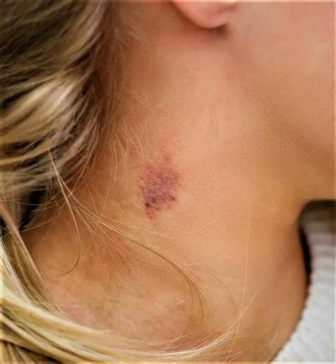 How To Get Rid Of Hickeys