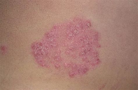 Mild Plaque Psoriasis Pictures Symptoms And Pictures