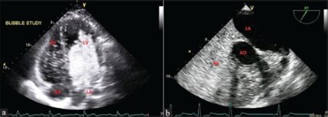 A Transthoracic Echocardiogram Bubble Study With Agit Open I
