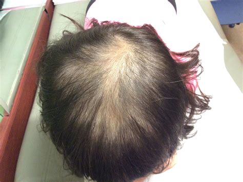 Genetic basis of alopecia areata: Alopecia Areata and Hypothyroidism | Endocrinology