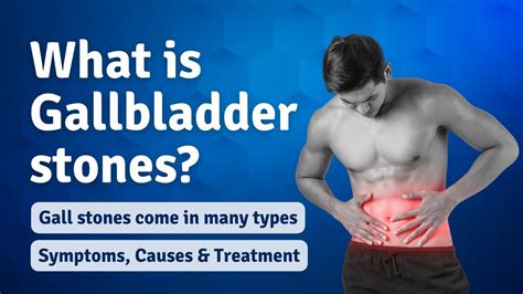 What Is Gallbladder Stones Gall Stones Come In Many Types