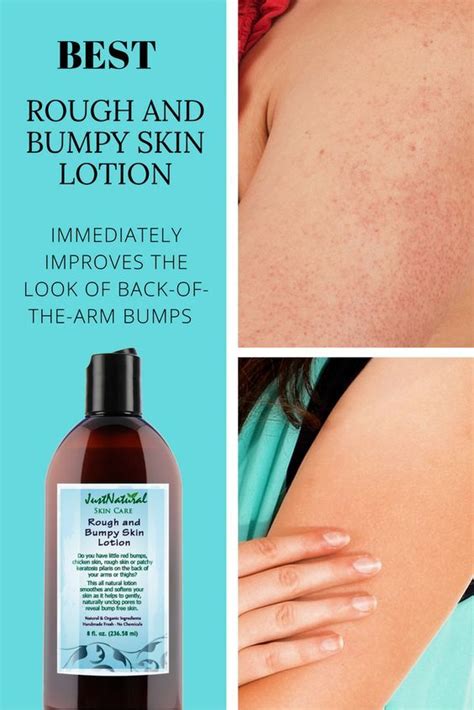 Rough Bumpy Skin Lotion You Can Finally Treat Those Annoying Back Of
