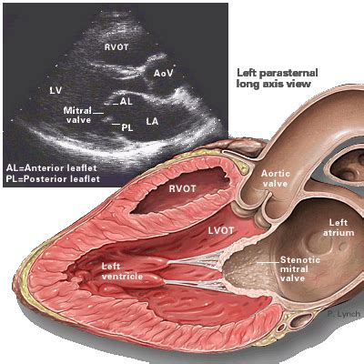 Mitral Valve Stenosis Topic Review Learn The Heart