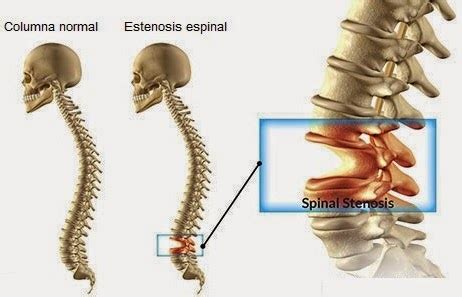 Columna Vertebral Estenosis Espinal Causas S Ntomas Y Tratamiento
