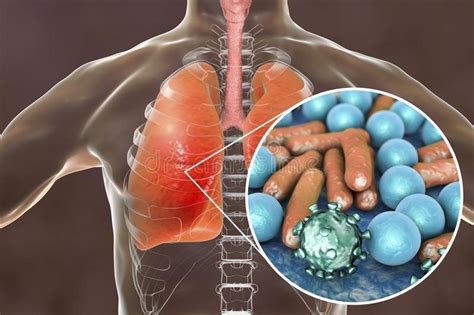 Pneumonia Medical Concept Illustration Showing Human