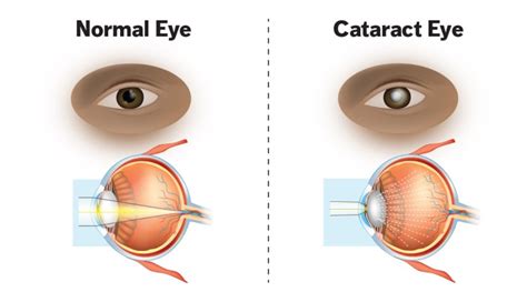 Cataracts Icare Surgical And Optical Centre