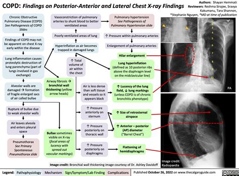 Copd Findings On Posterior Anterior And Lateral Chest X Ray Findings