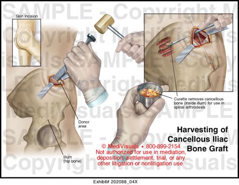 Harvesting Of Cancellous Iliac Bone Graft Medical Exhibit Medivisuals