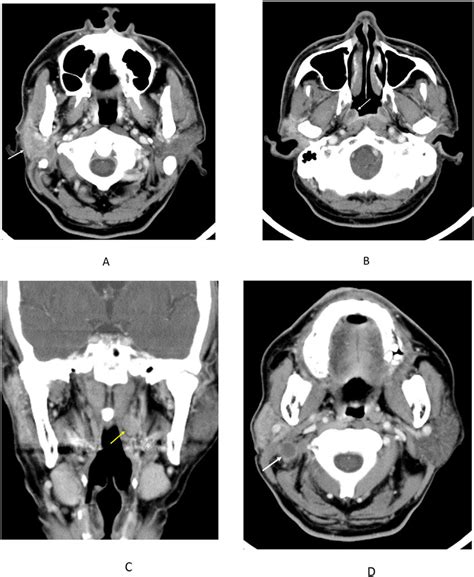 A Contrast Enhanced Axial Computed Tomography Ct Showed Diffuse