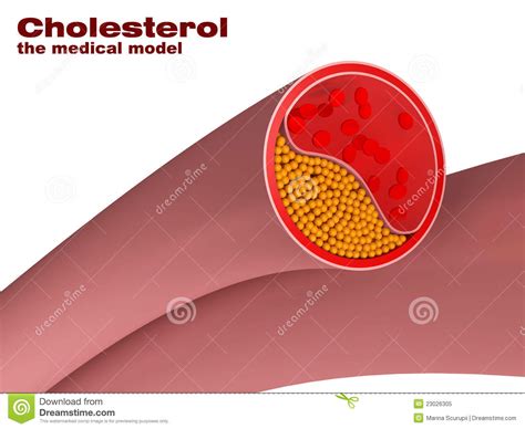 Model Of Cholesterol In Artery Stock Illustration - Illustration of ...