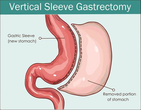 Sleeve Gastrectomy Wilmington Health