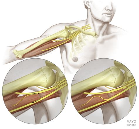 Distal Nerve Transfers To The Triceps Brachii Muscle Surgical