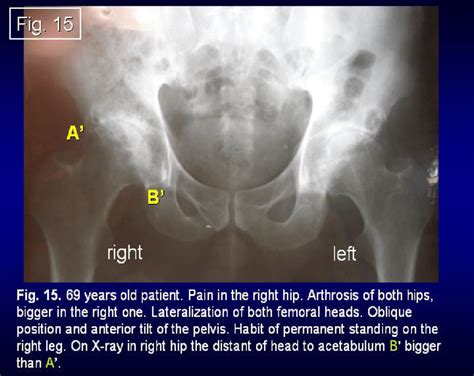Patient 69 Year Old Pain In Right Hip Arthrosis Of Both Hips Bigger